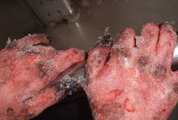 frostbite fingers